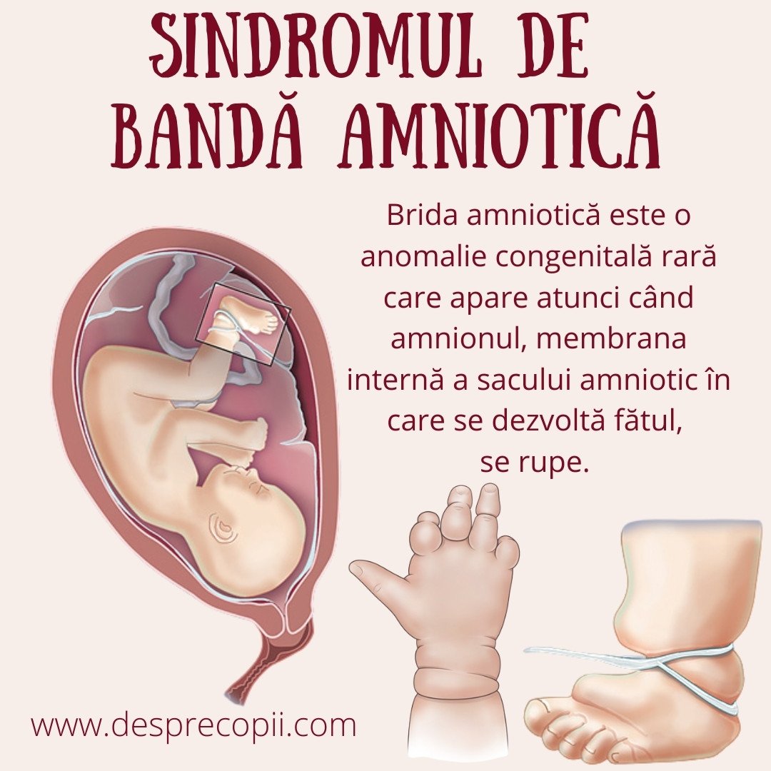 brida amniotica