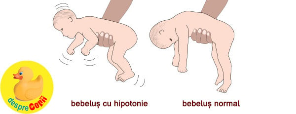 bebelus hipoton