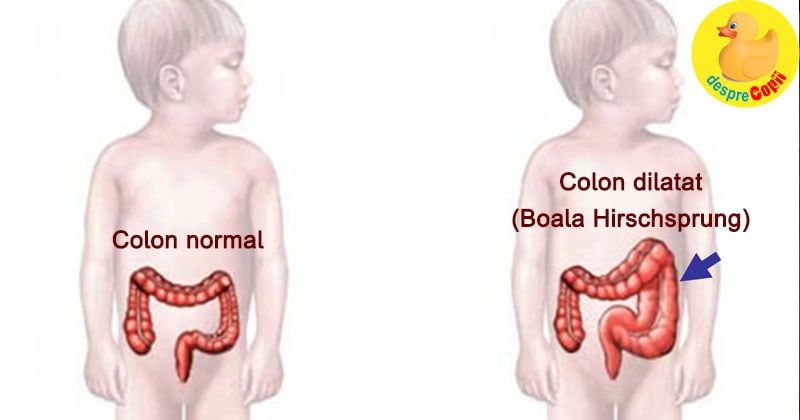 constipatie copil cauza