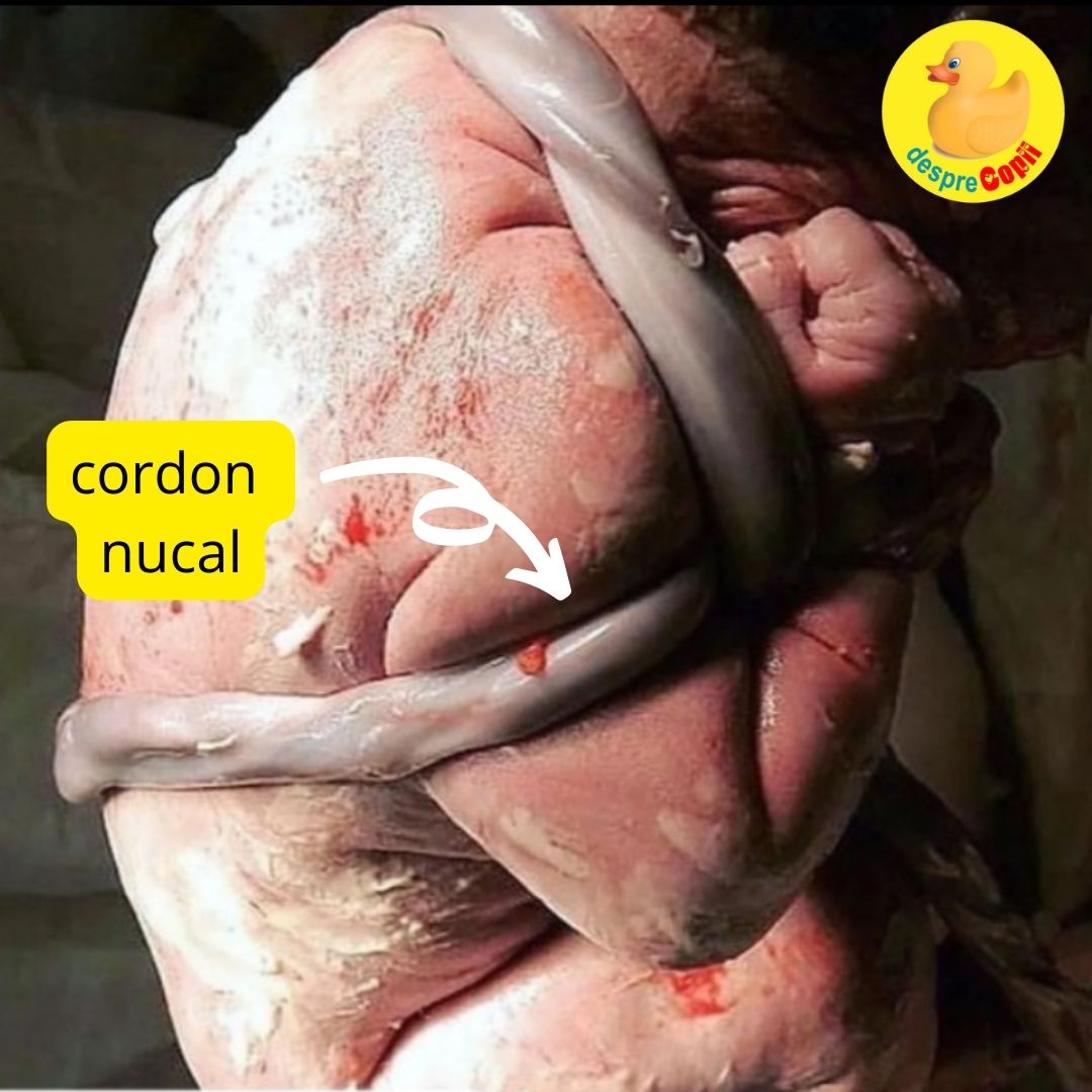 cordon nucal