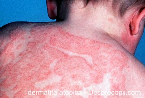 Dermatita atopica forum
