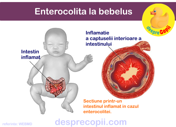 enterocolita bebelusi