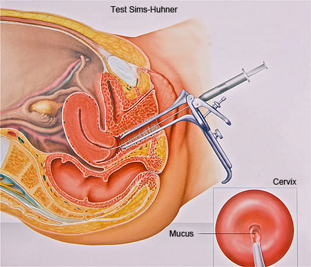 /Images/infertilitate-masculina-poza2-test-sims.jpg