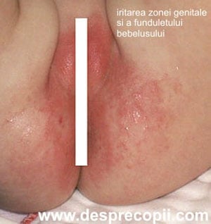 surprise To detect Production center Iritatia de scutec a bebelusului: cauze si tratament | Desprecopii.com