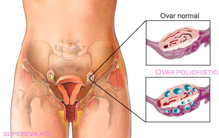 PCOS