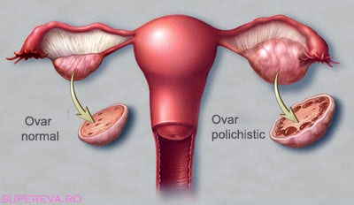 PCOS