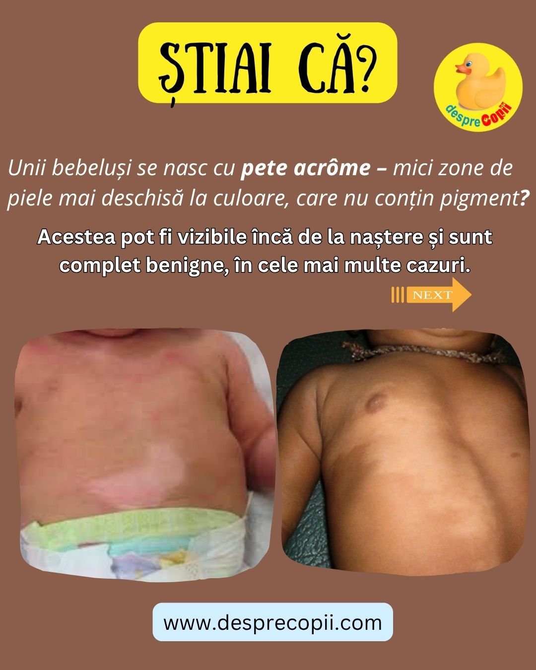 pata acroma semn din nastere bebe 1