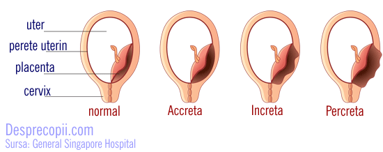 tipuri placenta
