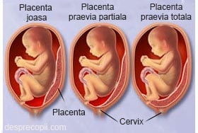 placenta sarcina