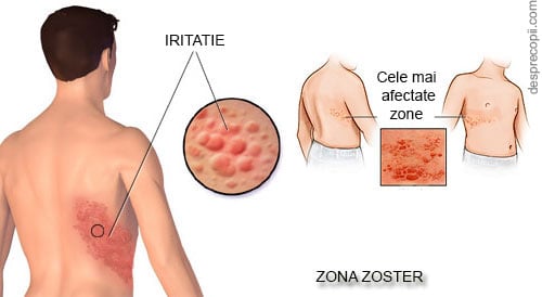 Zona Zoster