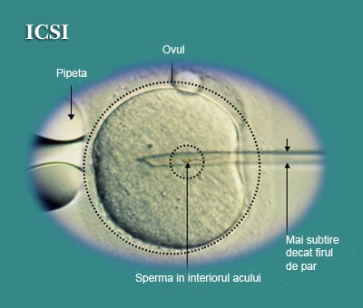 /Images/procedura-icsi.jpg