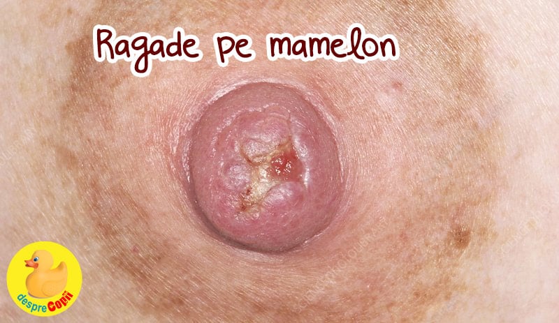 ragade mamelon