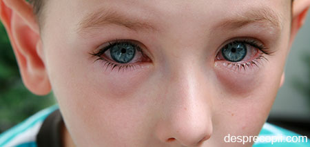 Rinita Alergica La Copil Desprecopii Com