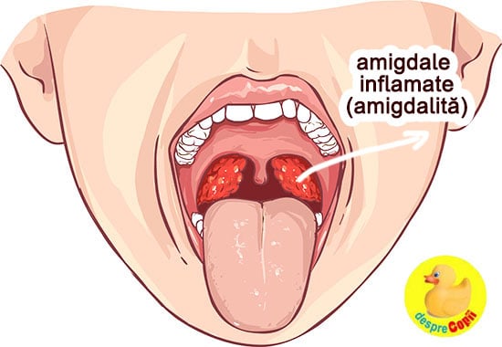 amigdalita