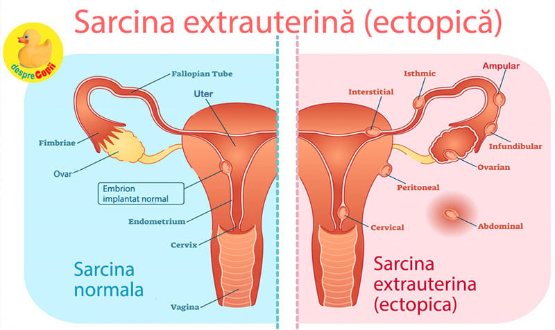 sarcina extrauterina cauze