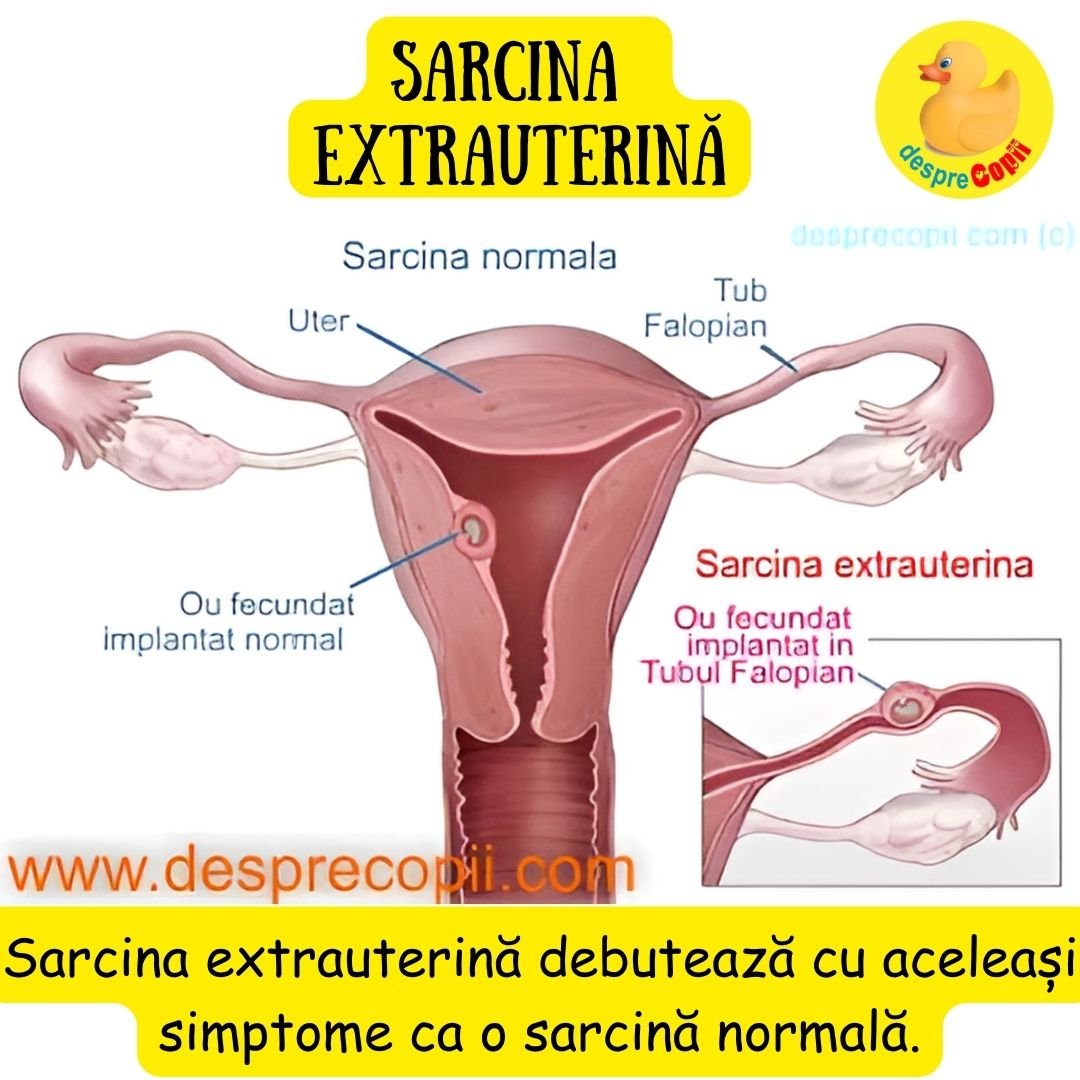 sarcina extrauterina