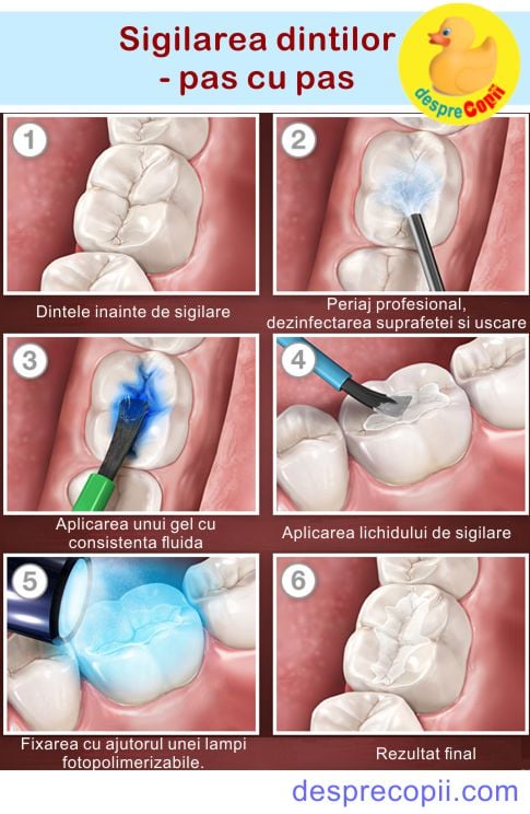 sigilare dinti de lapte