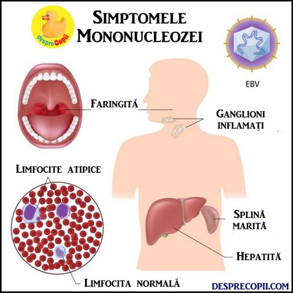 Mononucleoza La Copil Simptome Si Tratament Desprecopii Com