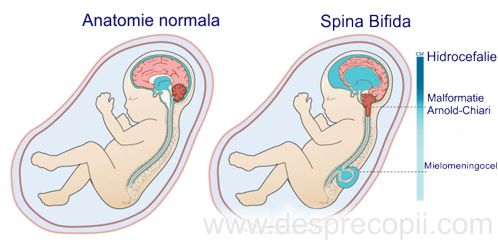 spina bifida