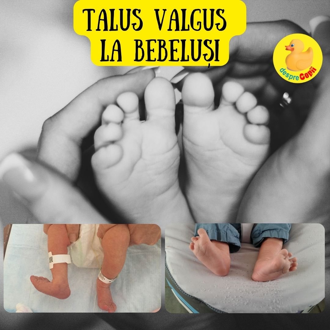 talus valgus bebelusi