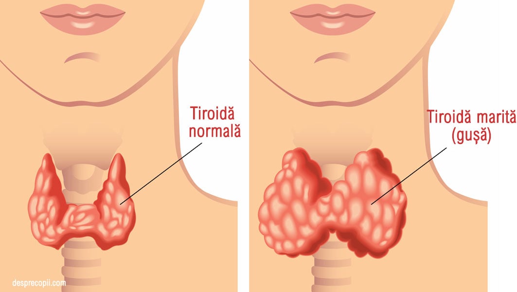 tiroida sarcina