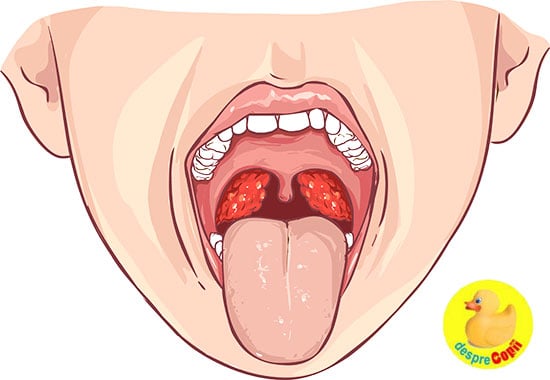 Amigdalita Tonsilita La Copil Cauze și Tratament Desprecopii Com