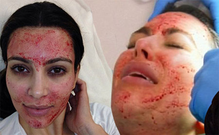 /Images/tratament-facial-vampir.jpg