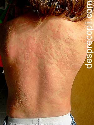 Urticaria La Copil Cauze Tipuri Si Tratament Desprecopii Com