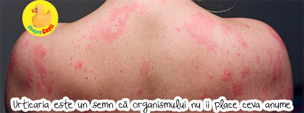 Urticaria Tipuri Cauze și Cum Se Poate Manifesta Desprecopii Com