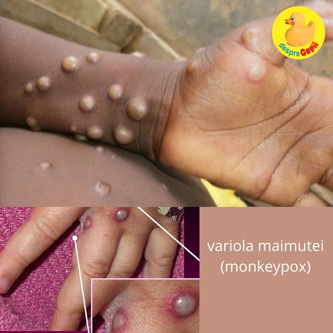 variola maimutei monkeypox