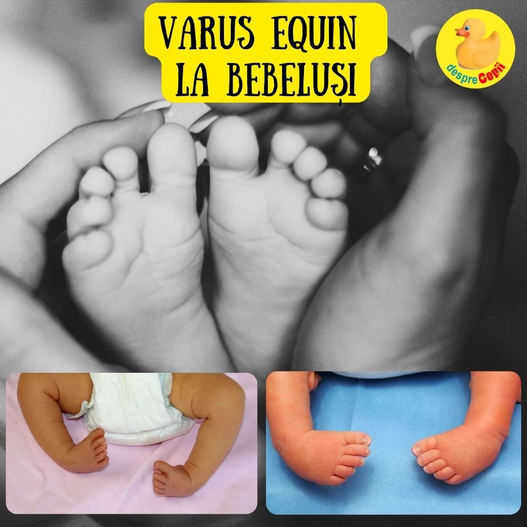 varus equin la bebelusi