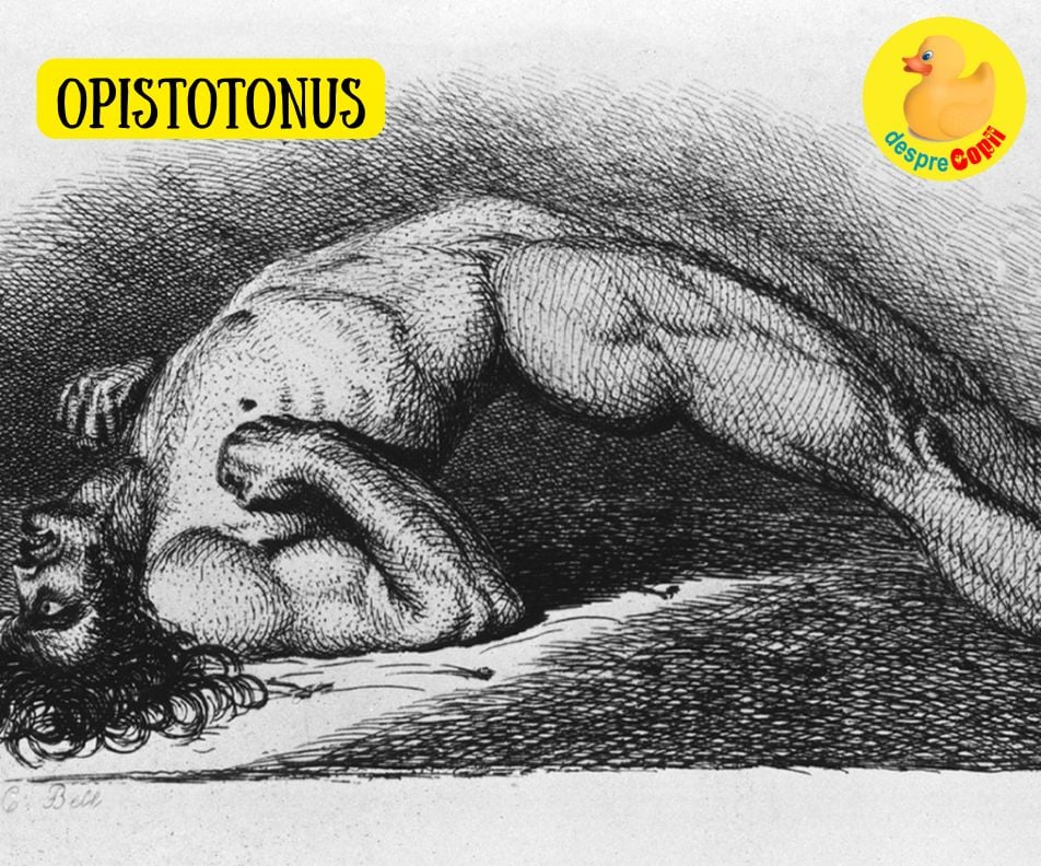 Opistotonusul - ce este si cum se trateaza