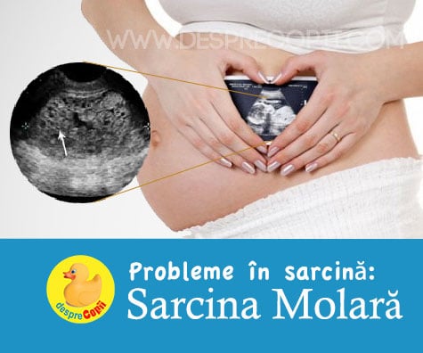 Sarcina Molara. Desi incepe ca o sarcina normala nu are sanse. Cauze si interventie.