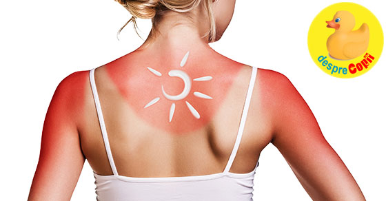Arsurile solare: 19 tratamente si remedii la indemana cand pielea e arsa de soare