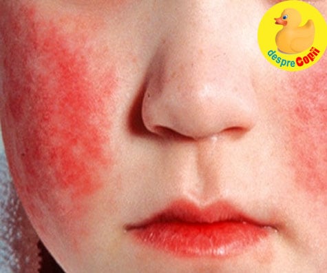 Boala obrajilor pălmuiti - dacă ai un copil la gradiniță sau la scoală iată ce trebuie să știi