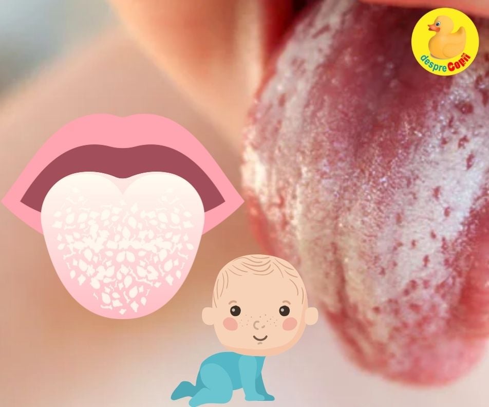 Candidoza bucală la bebeluși: simptome și tratament
