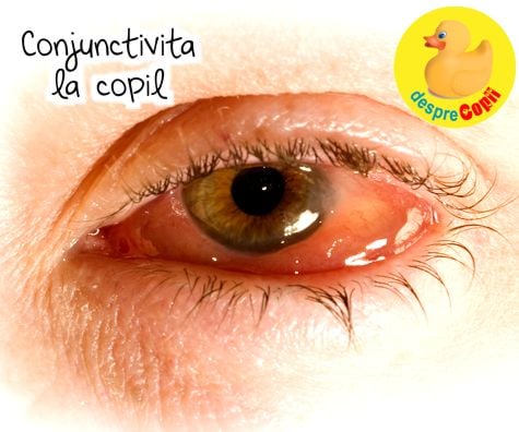 Conjunctivita la copil