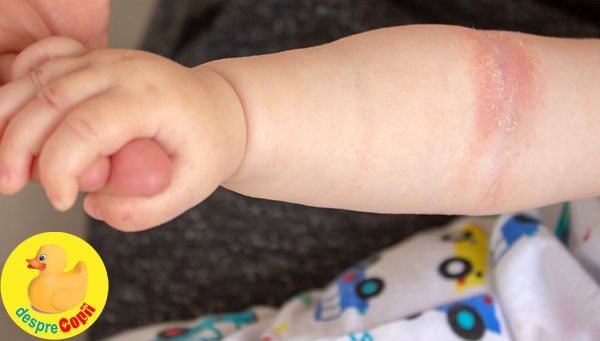 Cremele și produsele pentru bebeluși pot favoriza eczema - iată sfatul medicului dermatolog