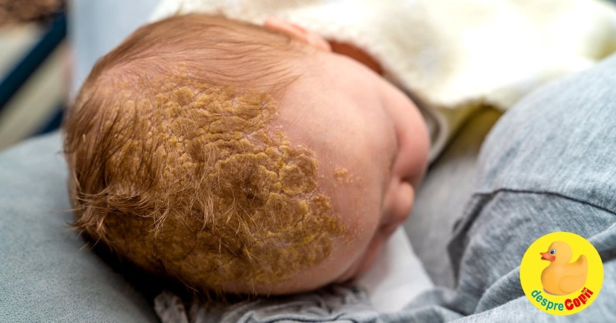 Crusta de lapte sau dermatita seboreică infantilă - cauze și cum se tratează la bebeluși