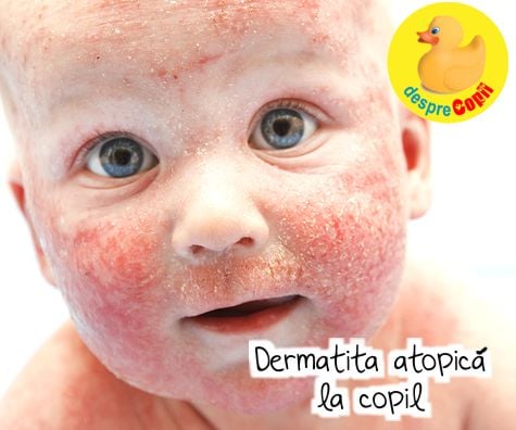 Dermatita atopica la copil: cauze si cum se trateaza- sfatul medicului