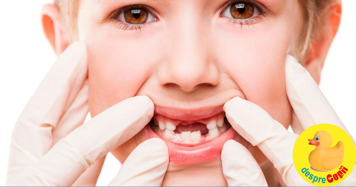 Ce se întamplă când copiii iși pierd prea devreme dinții de lapte? - sfatul medicului stomatolog pediatru