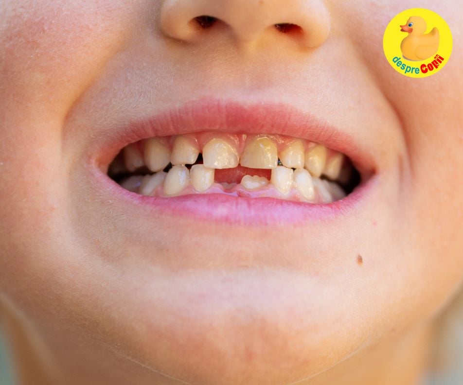 De ce se schimbă culoarea dinților de lapte? Cauze, soluții și sfaturi de la stomatologul pediatru