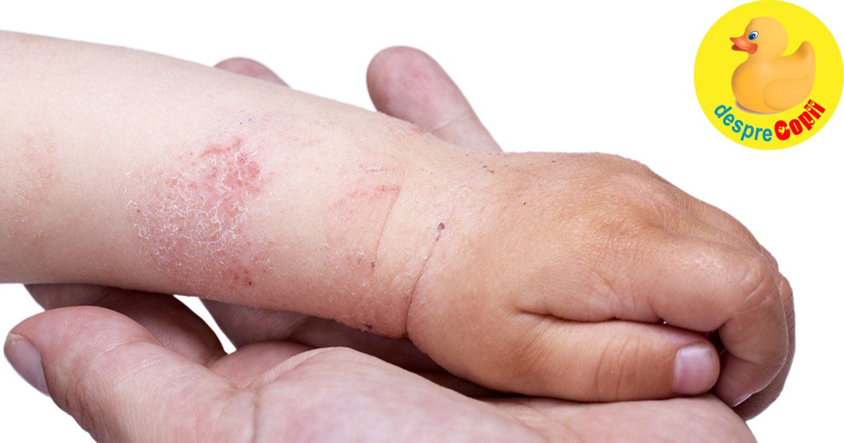 Eczema la copil. Legătura cu alergiile și cum se tratează - sfatul medicului dermatolog