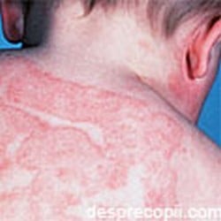 Dermatita atopica (eczema)