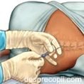 Anestezia epidurala
