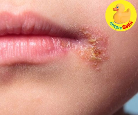 Impetigo la copil: simptome, tratament si preventie - sfatul medicului