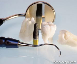 5 lucruri de stiut despre implanturile dentare 