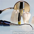 5 lucruri de stiut despre implanturile dentare
