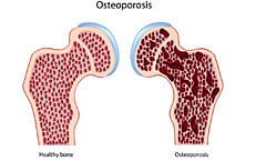 De ce apare osteoporoza?