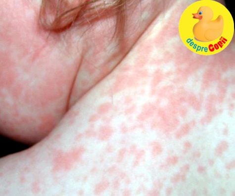 Roseola la copil: simptome si tratament - sfatul pediatrului